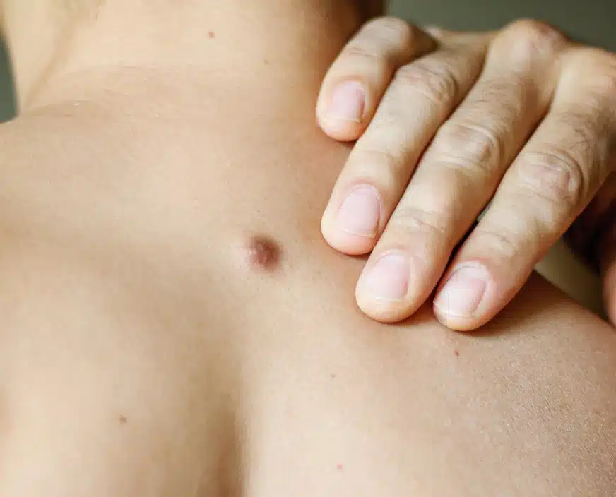 Distinguer les types de kystes | Clinique du Corps | Côtes-d'Armor