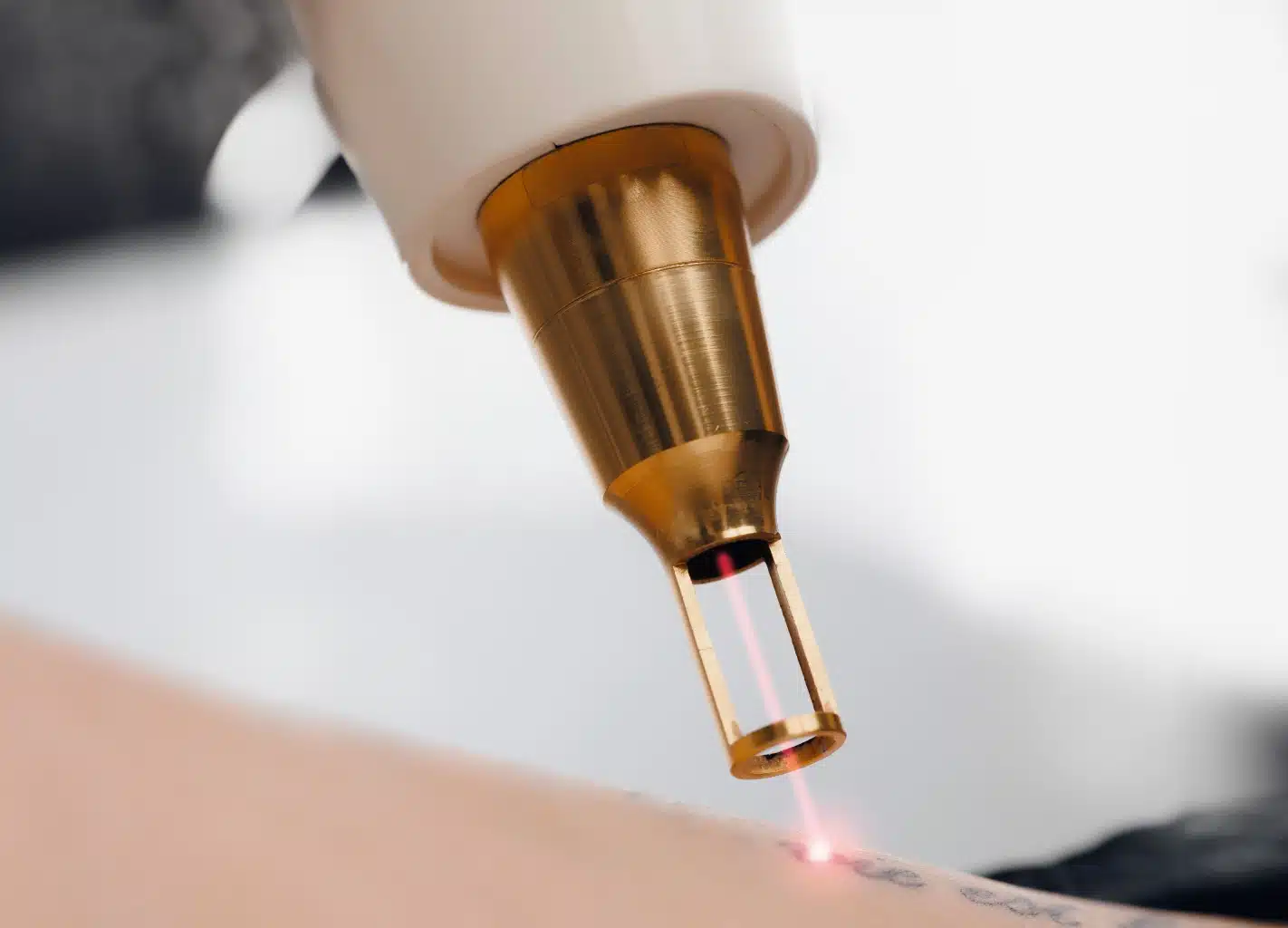 Détatouage laser à Lannion | Côtes-d'Armor | Clinique du Corps