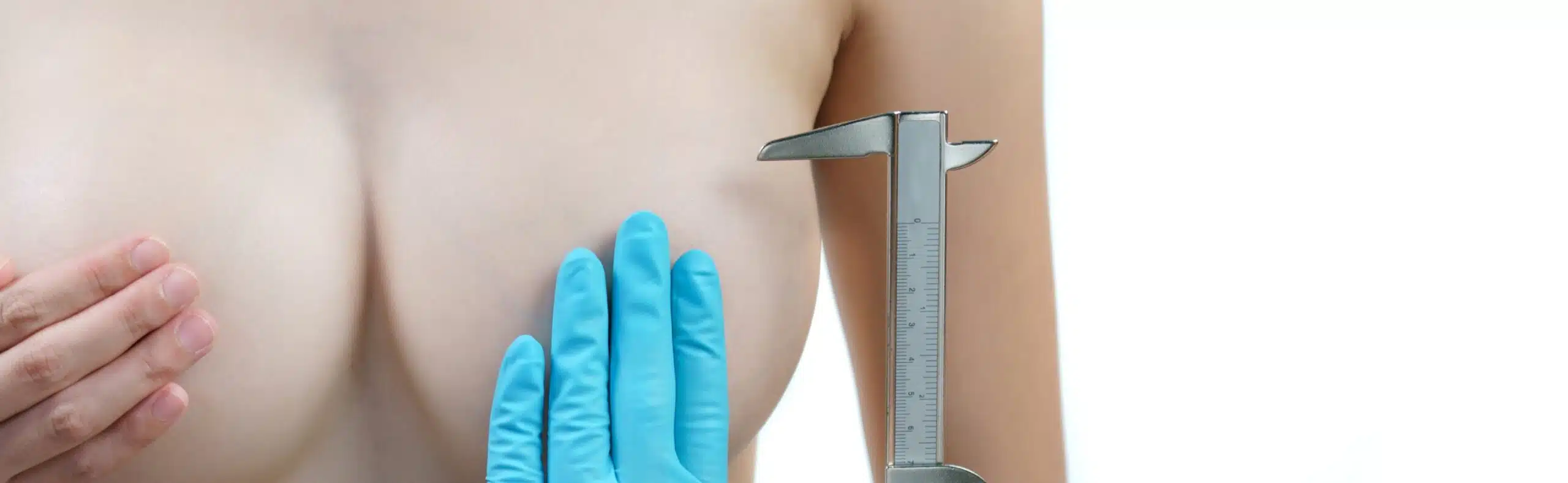 Les avantages d’une réduction mammaire sur la santé et la posture